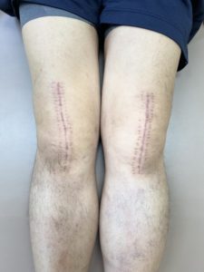 膝人工置換術後のリハビリ